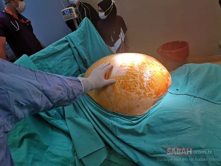 91 kilodan 70 kiloya düştü! Karnından çıkan doktorları şoke etti