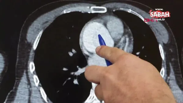 Mide ağrısı sandı, aort damarında yırtık çıktı | Video