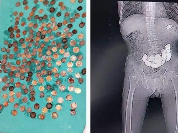 X-Ray cihazına bakan doktorlar şaştı kaldı! Midesinden tam 187 tane çıkarıldı