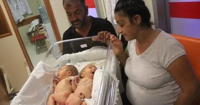 Hatay’da yapışık ikizler dünyaya geldi