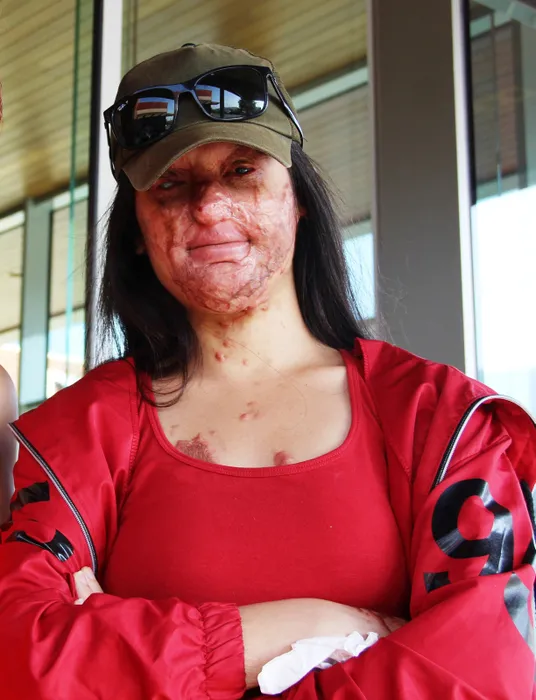 Yüzünü yakan kişiyle evlenen Berfin Özek herkesi şoke etti! Babası SABAH’a konuştu: Nasıl yapar bunu?