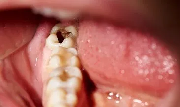 Bu besin çürük diş problemini ortadan kaldırıyor!