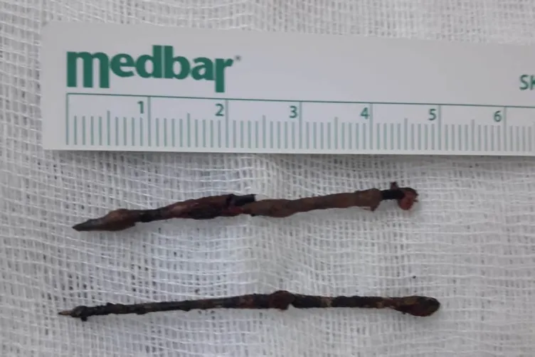 Vücudundan çıkan çuvaldızlar, doktorları şoke etti