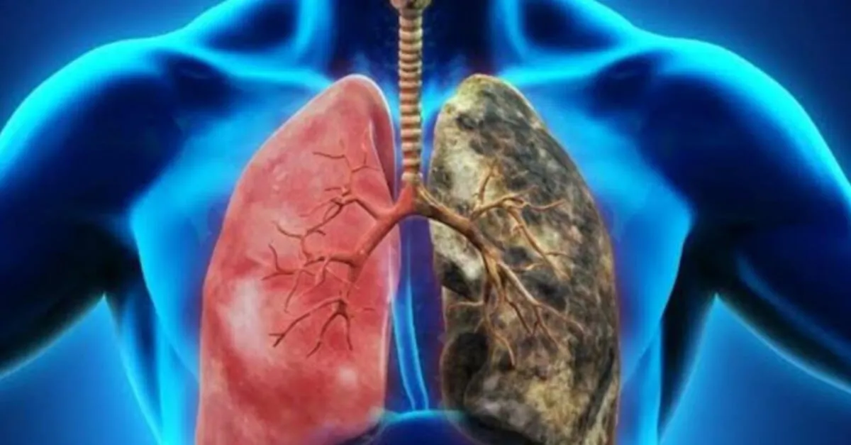 koah hastaligi belirtileri ve tedavi