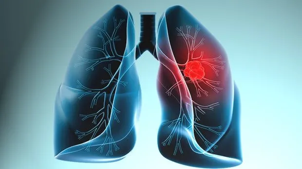 Akciğer kanserinde tehdit büyüyor!