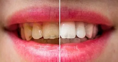 Bu yöntem sayesinde dişleriniz inci gibi olacak! İşte dişleri beyazlatmanın doğal yolları