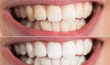 Dişleriniz sararsın istemiyorsanız çözümü çok basit! İşte diş sararmasını önlemenin yolları...