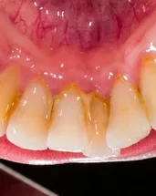 Bu yöntemle diş taşlarından kurtulun!