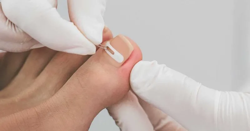 Tirnakta Batma Nasil Onlenir Evde Tirnak Batmasi Nasil Tedavi Edilir Iste Dogal Ve Bitkisel Tedavi Yontemleri Saglik Haberleri