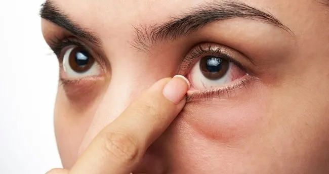 korona gunlerinde acil goz sorunlarina