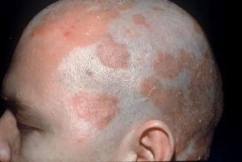 Seboreik Dermatit Nedir Nasil Tedavi Edilir Saglik Haberleri
