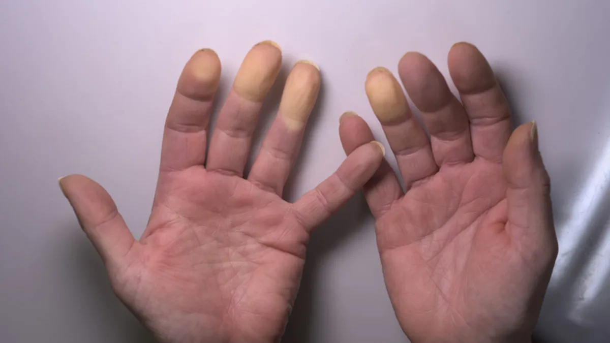 Soğukta parmaklarınız morarıyorsa dikkat! Raynaud hastalığının habercisi olabilir Soğukta parmaklarınız morarıyorsa dikkat! Raynaud hastalığının habercisi olabilir