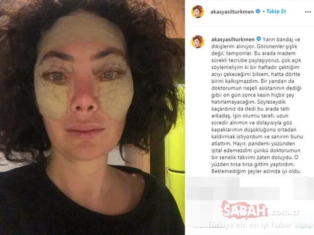 Akasya Asıltürkmen estetikli halini sosyal medyadan paylaştı! Yeni halini ti’ye aldı! Uzaylı filtresi gibi