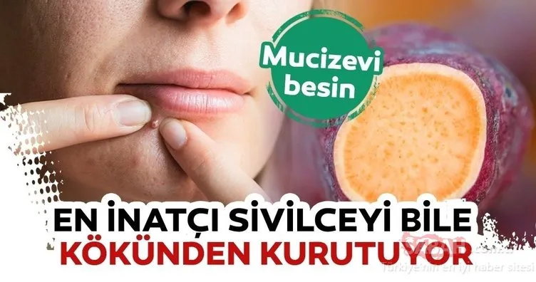 En inatçı sivilceyi bile kökünden kurutuyor! İşte mucize besin