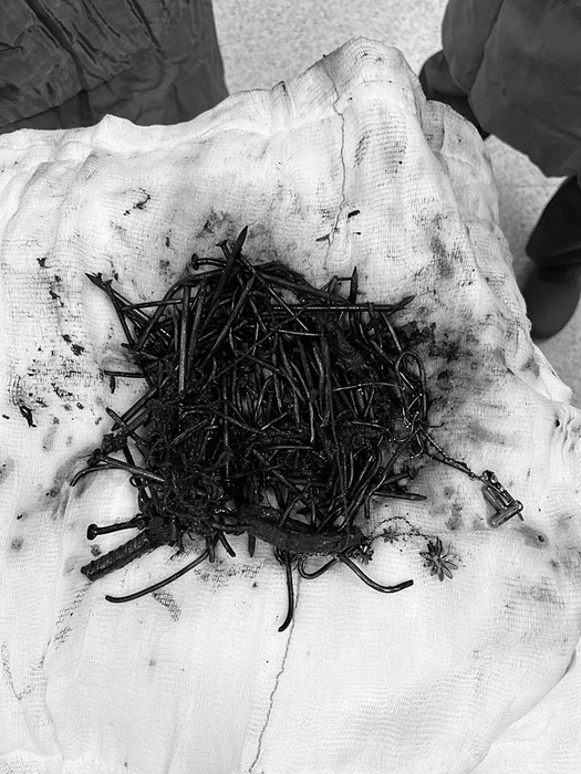 Doktorlar gözlerine inanamadı: Midesinden 1 kilo metal çıktı! İnşaat demiri bile var