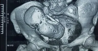 35 yıl süren hamilelik! 73 yaşındaki kadının karnındaki bebek taşlaşmış