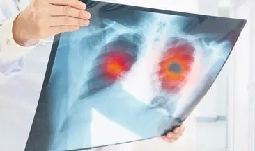 Akciğer kanserinde yeni tedavi yöntemleri sağ kalım süresini artırıyor