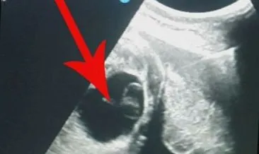 kisti belirtileri nelerdir