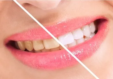 Uzmanı açıkladı: Dişlerinizin sararmasının asıl nedeni! Eğer böyle fırçalıyorsanız…
