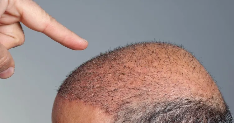 Kelliğin tek çaresi saç ekim ameliyatlarıdır!