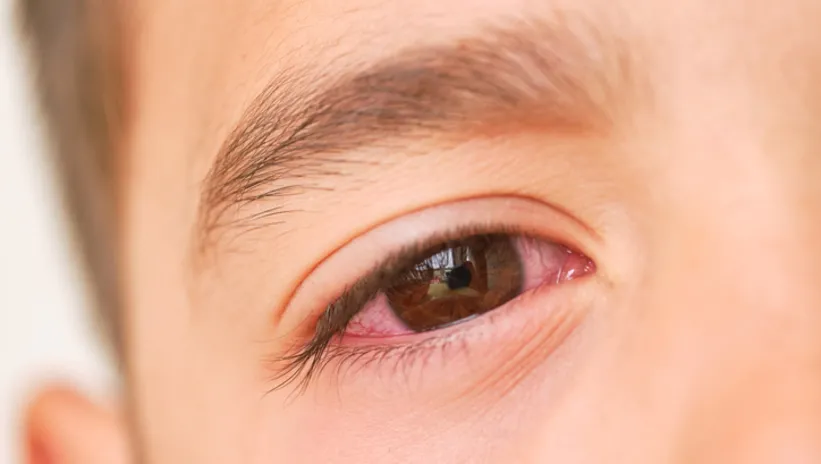 OKULLARDA GÖZ ENFEKSİYONU ALARMI