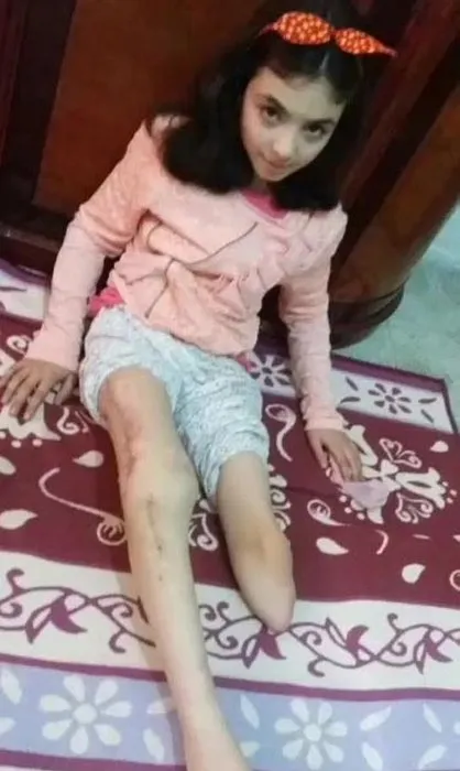Suriye’deki savaşta bacağını kaybeden Nur, şimdi patenle kayıyor
