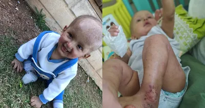 Ne güneşe çıkabiliyor ne sıcağa! Küçük Muhammet’in hayatı kabusa döndü: Çok fazla kriz geçiriyor...