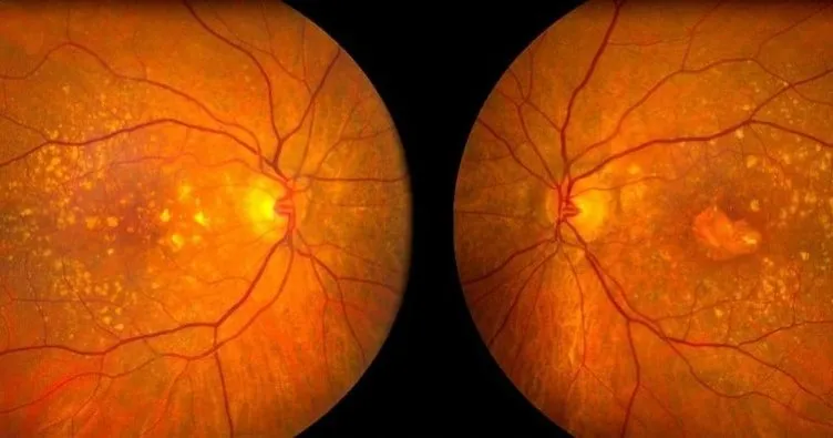 Gözde sarı nokta hastalığı belirtileri nelerdir? Sarı nokta hastalığı neden olur, nasıl geçer?