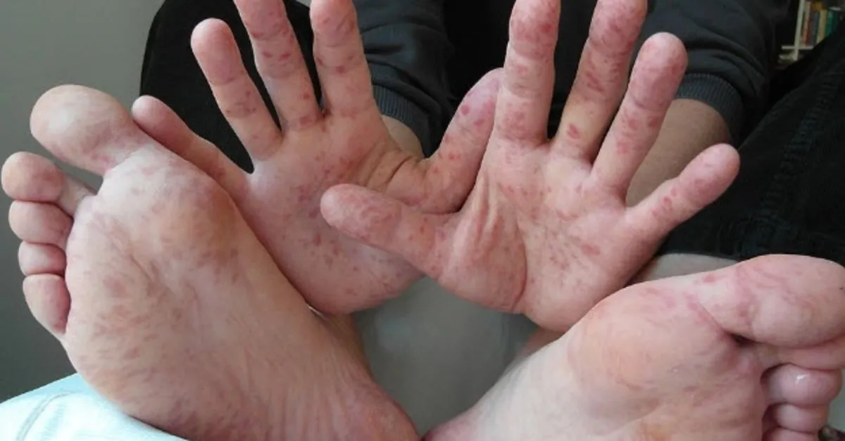 El Ayak Agiz Hastaligi Nedir El Ayak Agiz Hastaligi Belirtileri Nelerdir Saglik Haberleri