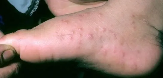 Cocuklarda El Ayak Agiz Hastaligina Dikkat Sabah