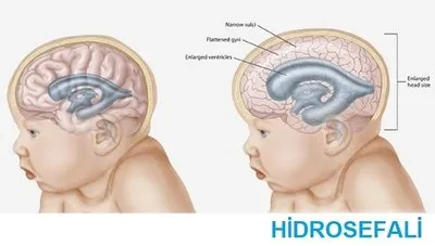 bebeginizin bas cevresini mutlaka olcturun bebek haberleri