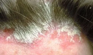 Sac Egzamasina Ne Iyi Gelir Sacta Seboreik Dermatit Dogal Tedavi Ile Nasil Gecer Saglik Haberleri