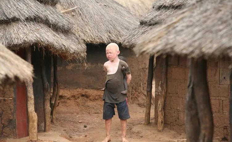 Tanzanya’da albino vakaları