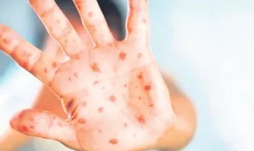 Maymun çiçeği vakaları artıyor