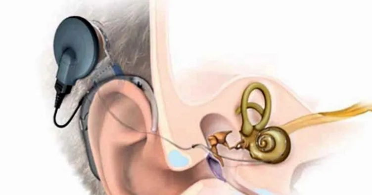 Biyonik kulak ile duymaya başladı