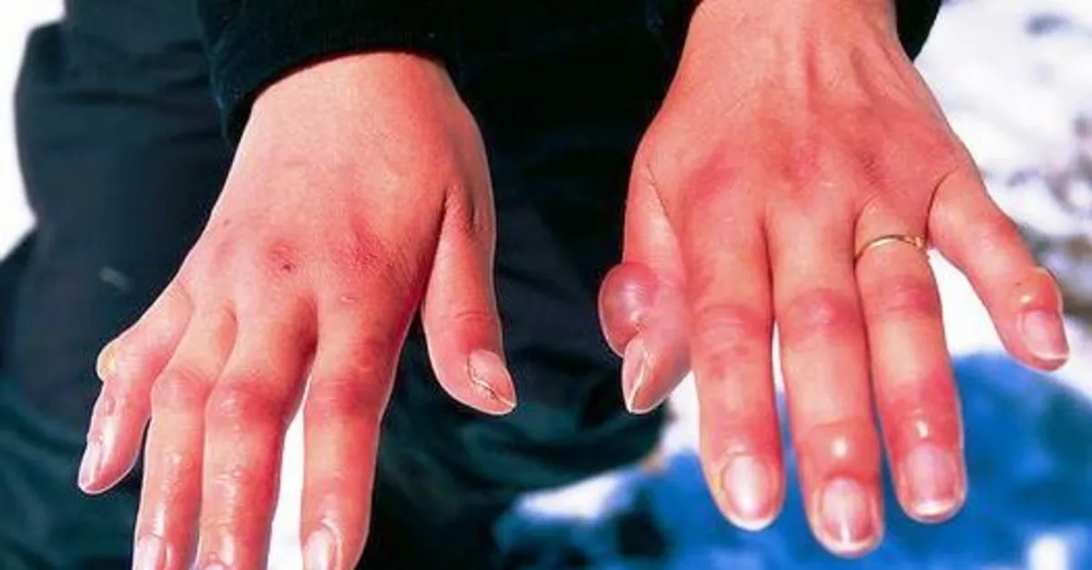 soguk isirmasi nedir saglik haberleri