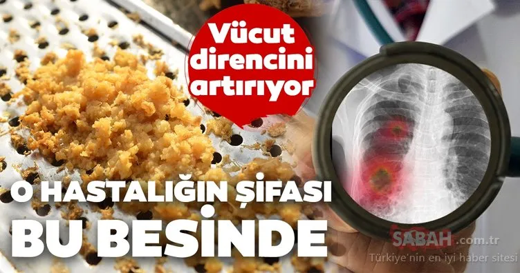 Zatürre belirtileri nelerdir? İşte pnömoni zatürre belirtileri ve iyi gelen doğal gıdalar...