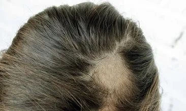 Saçkıran nedir, neden olur? Saçkıran belirtileri, tanı ve tedavi yöntemleri