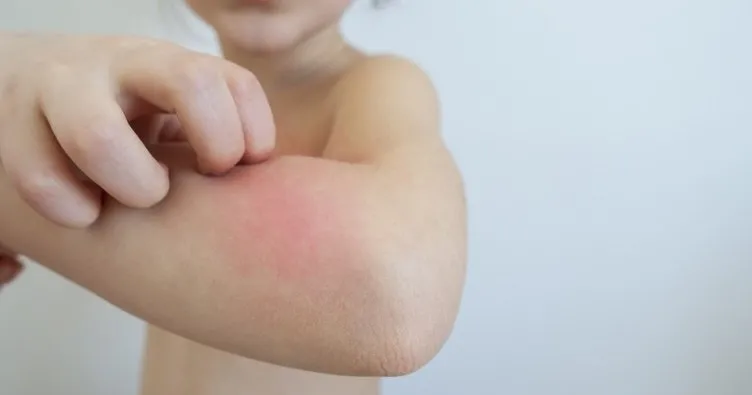 Cocugunuz Alerjik Bunyeli Olabilir Cocuk Haberleri