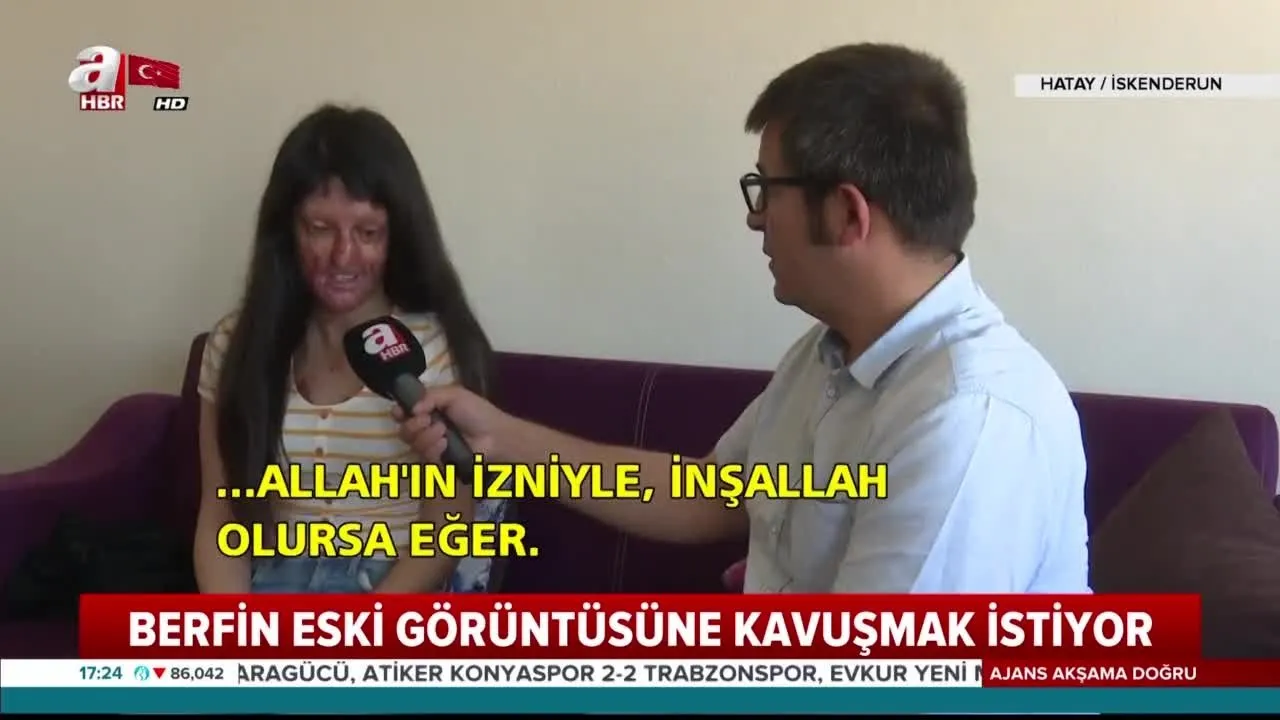 erkek arkadasinin asitli saldirisi sonucu yuzu yanan berfin eski goruntusune kavusmak istiyor