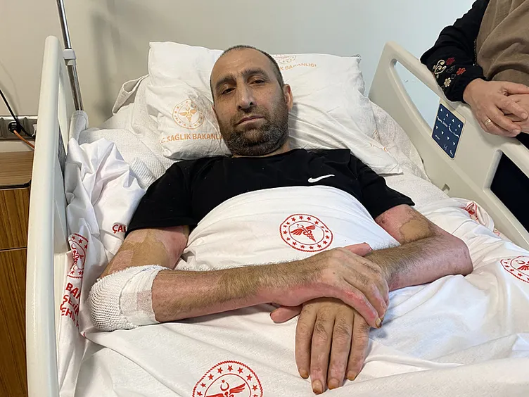 Mangal keyfi faciayla bitti! Vücudunun yüzde 80’i yandı: 10 ameliyat geçirdi...