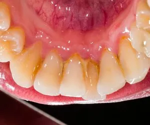 Diş taşlarından kurtulmak için bu yöntemi deneyin! İşte dişleri temizleyen süper yöntem...