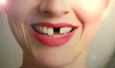 Rüyada Diş Dökülmesi Ne Anlama Gelir? Rüyada Diş Dökülmesi, Diş Kırılması Görmenin Anlamı ve Tabiri