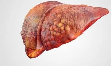 Karaciğer yağlanması nedir? Karaciğer yağlanması nedenler nelerdir?