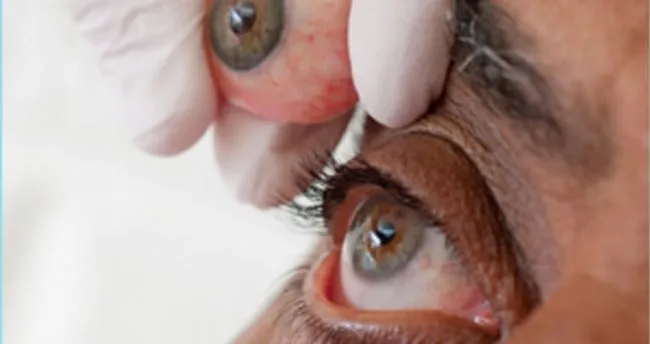 Göz protezi kimlere uygulanır? Hareketli göz protezi ne demektir?