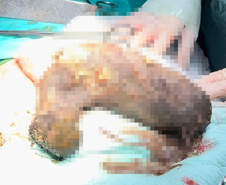 Doktorlar bile şaşkın: Midesinden 50 santim saç yumağı çıktı!