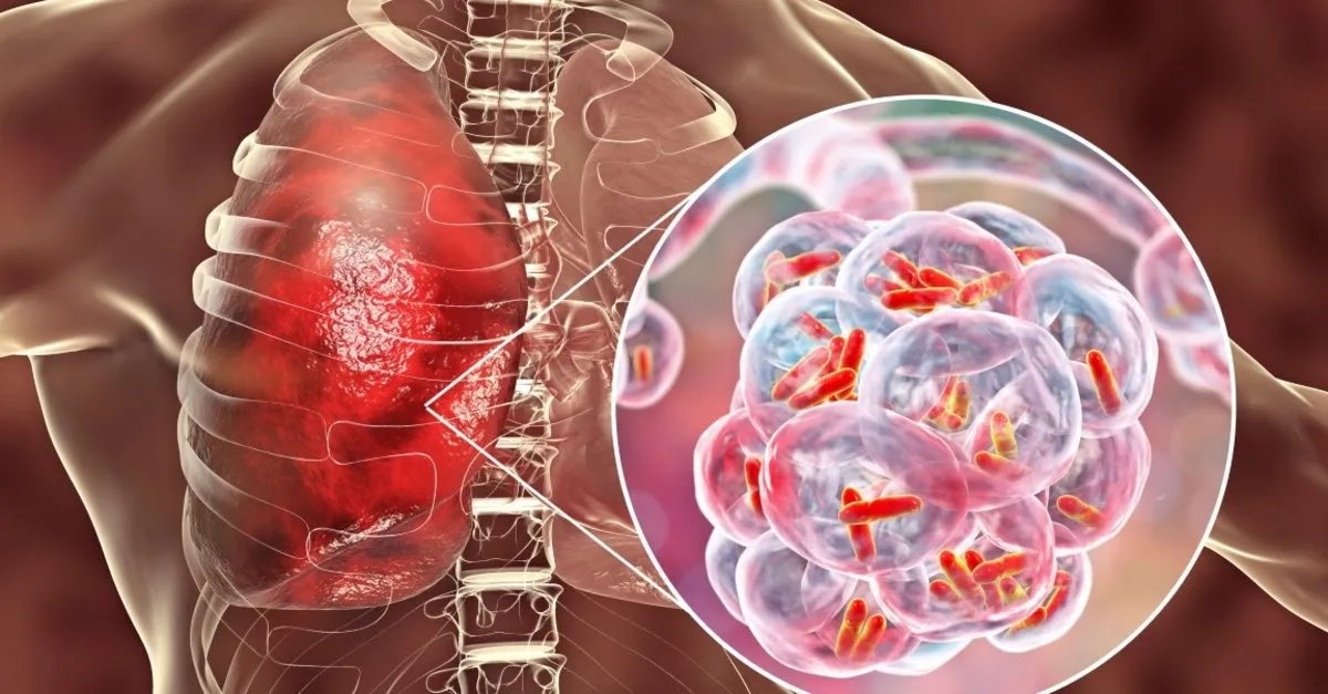 Grip sonrası oluşan akciğer iltihaplanmasına dikkat - Sağlık Haberleri