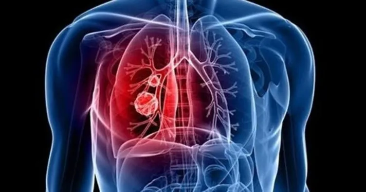 Akciğer enfeksiyonu belirtileri ve tedavisi: Akciğer enfeksiyonu neden olur, nasıl tedavi edilir?