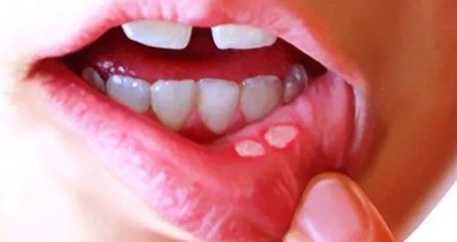 agiz yarasina ne iyi gelir evde dogal tedavi ile nasil gecer agiz yarasi bitkisel tedavisi saglik haberleri agiz yarasina ne iyi gelir evde dogal tedavi ile nasil gecer agiz yarasi bitkisel tedavisi saglik haberleri