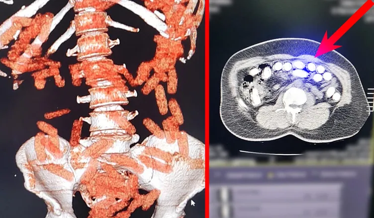Kayseri’de düzenlenen operasyonda midesinden çıkanlar şoke etti: Tam 1 kilo!